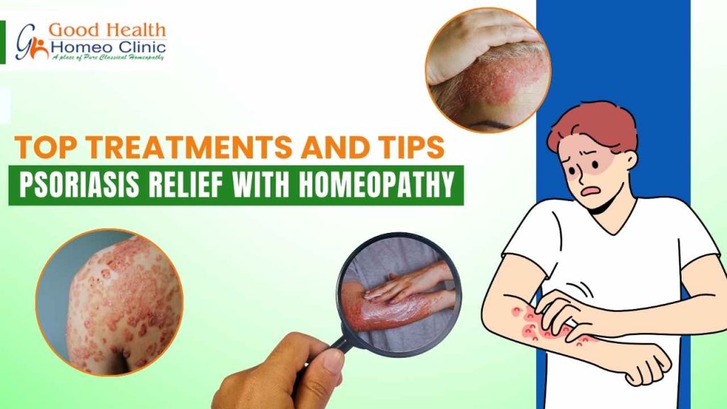 Psoriasis Relief with Homeopathy: Top Treatments and Tips