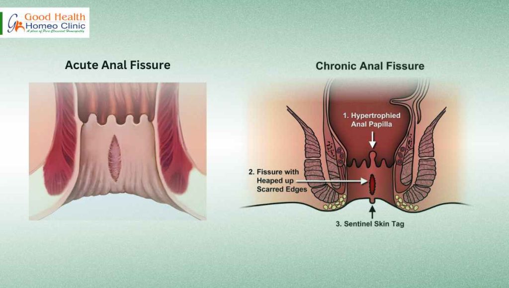 acute and chronic fissure